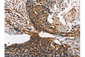 The image on the left is immunohistochemistry of paraffin-embedded Human esophagus cancer tissue using ABIN7190317(CNGA1 Antibody) at dilution 1/40, on the right is treated with synthetic peptide. (CNGA1 anticorps)