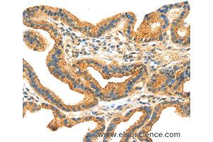Immunohistochemistry of Human thyroid cancer using RRAGA Polyclonal Antibody at dilution of 1:30