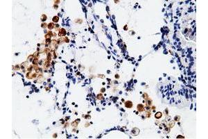 Immunohistochemical staining of paraffin-embedded Adenocarcinoma of Human breast tissue using anti-CD80 mouse monoclonal antibody. (CD80 anticorps)