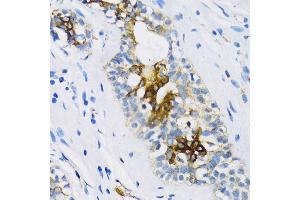 Immunohistochemistry of paraffin-embedded Human breast using PTCH1 antibody (ABIN1682368, ABIN1682367, ABIN3015342, ABIN3015343 and ABIN6213997) at dilution of 1:100 (40x lens). (Patched 1 anticorps  (AA 1214-1312))