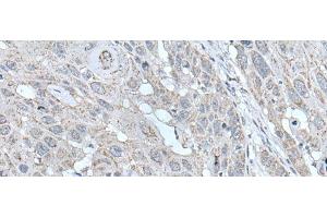 Immunohistochemistry of paraffin-embedded Human esophagus cancer tissue using SCNN1G Polyclonal Antibody at dilution of 1:40(x200)