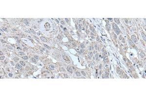 Immunohistochemistry of paraffin-embedded Human esophagus cancer tissue using SCNN1G Polyclonal Antibody at dilution of 1:40(x200) (SCNN1G anticorps)