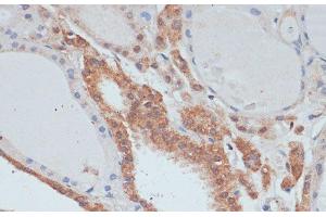 Immunohistochemistry of paraffin-embedded Human thyroid cancer using MYCBP Polyclonal Antibody at dilution of 1:100 (40x lens). (MYCBP anticorps)