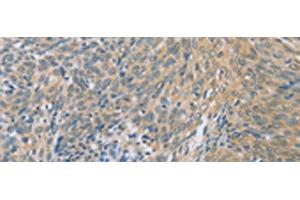 Immunohistochemistry of paraffin-embedded Human cervical cancer tissue using ZHX3 Polyclonal Antibody at dilution of 1:100(x200) (ZHX3 anticorps)