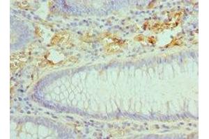 Immunohistochemistry of paraffin-embedded human colon cancer using ABIN7145996 at dilution of 1:100