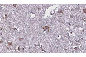 ABIN6275754 at 1/100 staining Human brain cancer tissue by IHC-P. (GNE anticorps)