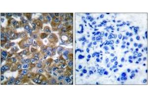 Immunohistochemistry analysis of paraffin-embedded human breast carcinoma tissue, using Keratin 15 Antibody. (KRT15 anticorps  (AA 1-50))