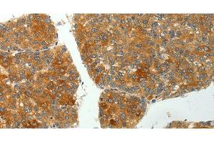 Immunohistochemistry of paraffin-embedded Human liver cancer using SH-PTP1 Polyclonal Antibody at dilution of 1:35 (SHP1 anticorps)