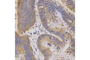 Immunohistochemistry of paraffin-embedded human rectal cancer using P2RY11 antibody (ABIN5971564) at dilution of 1/200 (40x lens). (P2RY11 anticorps)