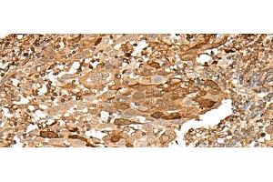 Immunohistochemistry of paraffin-embedded Human cervical cancer tissue using PIEZO2 Polyclonal Antibody at dilution of 1:55(x200) (PIEZO2 anticorps)