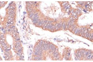 Immunohistochemistry of paraffin-embedded Human colon carcinoma using KCNH2 Polyclonal Antibody at dilution of 1:100 (40x lens).
