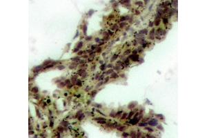 Immunohistochemistry (IHC) image for anti-V-Akt Murine Thymoma Viral Oncogene Homolog 1 (AKT1) (pThr308) antibody (ABIN3020076) (AKT1 anticorps  (pThr308))