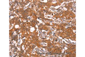 Immunohistochemistry of Human gastric cancer using FUT1 Polyclonal Antibody at dilution of 1:30