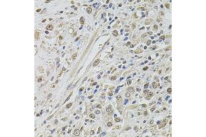 Immunohistochemistry of paraffin-embedded human prostate cancer using SMARCC2 antibody. (SMARCC2 anticorps)
