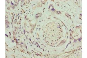 Immunohistochemistry of paraffin-embedded human pancreatic cancer using ABIN7171798 at dilution of 1:100 (SLC26A8 anticorps  (AA 414-595))
