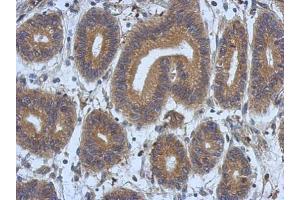 IHC-P Image Immunohistochemical analysis of paraffin-embedded human colon carcinoma, using DNAJB12, antibody at 1:500 dilution. (DNAJB12 anticorps  (Center))