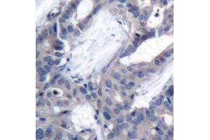 Immunohistochemistry of paraffin-embedded human breast carcinoma using Phospho-MAP2K2-T394 antibody (ABIN2987359). (MEK2 anticorps  (pThr394))