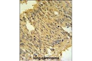 MFRN2 Antibody (N-term) (ABIN651437 and ABIN2840240) IHC analysis in formalin fixed and paraffin embedded human lung carcinoma followed by peroxidase conjugation of the secondary antibody and DAB staining.