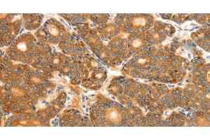 Immunohistochemistry of paraffin-embedded Human thyroid cancer tissue using SCT Polyclonal Antibody at dilution 1:40 (Secretin anticorps)