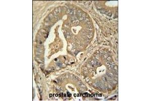 ISCA2 antibody (Center) (ABIN654448 and ABIN2844182) immunohistochemistry analysis in formalin fixed and paraffin embedded human prostate carcinoma followed by peroxidase conjugation of the secondary antibody and DAB staining.