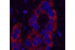 Immunofluorescence analysis of Human liver cancer tissue using NFKBIB Monoclonal Antibody at dilution of 1:200. (NFKBIB anticorps)