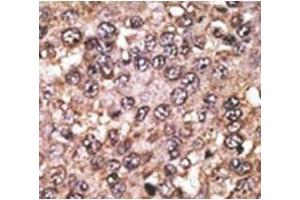 IHC analysis of FFPE human hepatocarcinoma tissue stained with the SIRT5 antibody (SIRT5 anticorps  (AA 263-292))