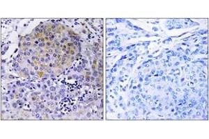 Immunohistochemistry analysis of paraffin-embedded human breast carcinoma tissue, using CEP78 Antibody. (CEP78 anticorps  (AA 301-350))