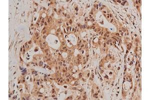 ABIN6267627 at 1/200 staining human colon cancer tissue sections by IHC-P. (FOXO1 anticorps  (pSer319))