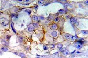 Immunohistochemistry (IHC) analyzes of p-EGFR antibody in paraffin-embedded human breast carcinoma tissue. (EGFR anticorps  (pTyr1197))