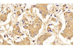 Detection of TUBb in Human Breast cancer Tissue using Monoclonal Antibody to Tubulin Beta (TUBb)