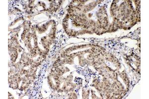 IHC analysis of XRCC1 using anti-XRCC1 antibody .
