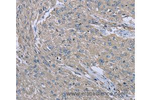 Immunohistochemistry of Human esophagus cancer using EZR Polyclonal Antibody at dilution of 1:30 (Ezrin anticorps)