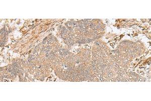 Immunohistochemistry of paraffin-embedded Human esophagus cancer tissue using FBXW8 Polyclonal Antibody at dilution of 1:65(x200) (FBXW8 anticorps)