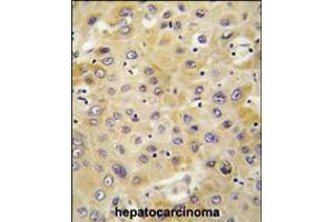 Formalin-fixed and paraffin-embedded human hepatocarcinoma tissue reacted with PPBP antibody , which was peroxidase-conjugated to the secondary antibody, followed by DAB staining. (PEBP1 anticorps  (C-Term))