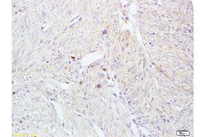 Formalin-fixed and paraffin embedded human breast carcinoma tissue labeled with Anti-CD161 Polyclonal Antibody, Unconjugated at 1:200 followed by conjugation to the secondary antibody and DAB staining (CD161 anticorps  (AA 151-225))