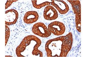 Formalin-fixed, paraffin-embedded human Colon Carcinoma stained with Cytokeratin 18 Mouse Monoclonal Antibody (KRT18/834).