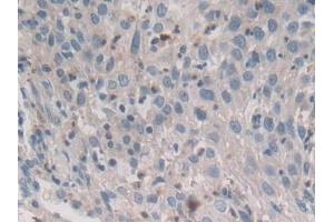 Detection of STX2 in Human Lung cancer Tissue using Polyclonal Antibody to Syntaxin 2 (STX2) (STX2 anticorps  (AA 8-262))