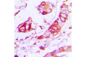 Immunohistochemical analysis of APLP2 staining in human lung cancer formalin fixed paraffin embedded tissue section.