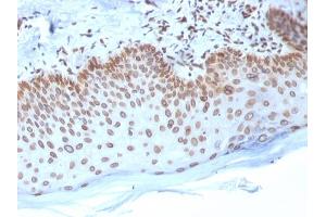 Formalin-fixed, paraffin-embedded human Breast Carcinoma stained with Emerin Mouse Monoclonal Antibody (EMD/2168).