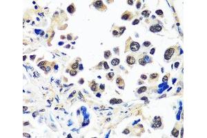 Immunohistochemistry of paraffin-embedded Human lung cancer using CAND1 Polyclonal Antibody at dilution of 1:100 (40x lens). (CAND1 anticorps)