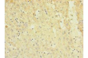 Immunohistochemistry of paraffin-embedded human liver cancer using ABIN7172869 at dilution of 1:100
