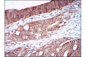 Immunohistochemical analysis of paraffin-embedded rectum cancer tissues using ZEB1 mouse mAb with DAB staining.