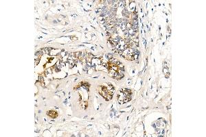 Immunohistochemistry of paraffin-embedded human breast cancer using MMP7 Rabbit mAb (ABIN7268425) at dilution of 1:150 (40x lens). (MMP7 anticorps)