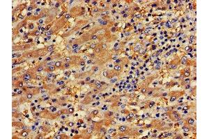 IHC image of ABIN7163576 diluted at 1:400 and staining in paraffin-embedded human liver cancer performed on a Leica BondTM system.