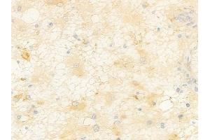 ABIN7096982 and ABIN7101049 at 1/100 staining human astrocytoma by IHC-P. (PROZ anticorps)
