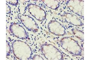 Immunohistochemistry of paraffin-embedded human colon cancer using ABIN7143191 at dilution of 1:100 (ACAD9 anticorps  (AA 1-270))