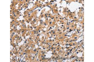 Immunohistochemistry of Human liver cancer using CLEC2D Polyclonal Antibody at dilution of 1:70