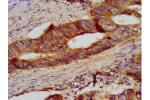 IHC image of ABIN7145452 diluted at 1:300 and staining in paraffin-embedded human colon cancer performed on a Leica BondTM system. (CSN2 anticorps  (AA 16-226))