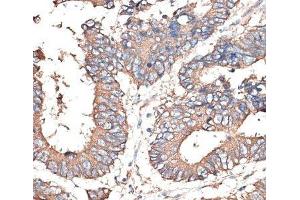 Immunohistochemistry of paraffin-embedded Human colon carcinoma using KRT81 Polyclonal Antibody at dilution of 1:100 (40x lens). (KRT81 anticorps)