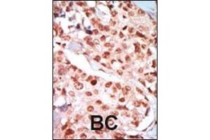 Formalin-fixed and paraffin-embedded human cancer tissue reacted with the primary antibody, which was peroxidase-conjugated to the secondary antibody, followed by DAB staining.